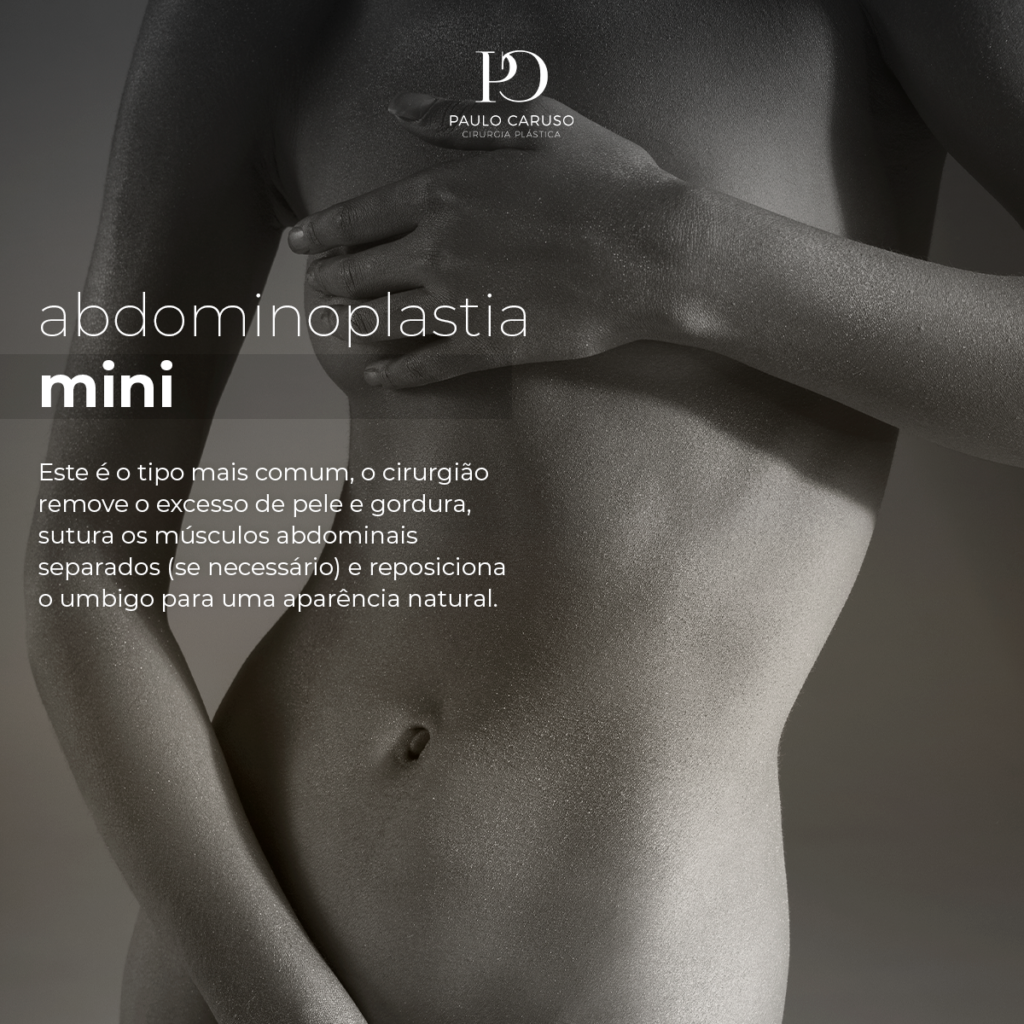 Tipos De Abdominoplastia Dr Paulo Caruso